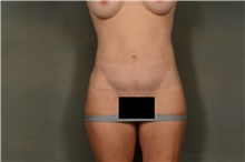 Tummy Tuck After Photo by Ellen Janetzke, MD; Bloomfield Hills, MI - Case 45627