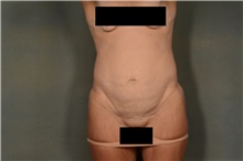 Tummy Tuck Before Photo by Ellen Janetzke, MD; Bloomfield Hills, MI - Case 45627