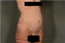 Tummy Tuck Before Photo by Ellen Janetzke, MD; Bloomfield Hills, MI - Case 45627
