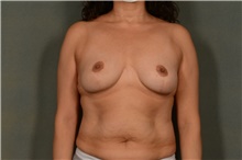 Breast Reduction After Photo by Ellen Janetzke, MD; Bloomfield Hills, MI - Case 45631