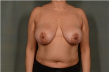 Breast Reduction Before Photo by Ellen Janetzke, MD; Bloomfield Hills, MI - Case 45631