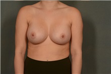 Breast Augmentation After Photo by Ellen Janetzke, MD; Bloomfield Hills, MI - Case 45632