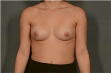 Breast Augmentation Before Photo by Ellen Janetzke, MD; Bloomfield Hills, MI - Case 45632