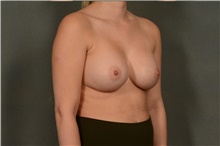 Breast Augmentation After Photo by Ellen Janetzke, MD; Bloomfield Hills, MI - Case 45632