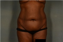 Tummy Tuck Before Photo by Ellen Janetzke, MD; Bloomfield Hills, MI - Case 45633