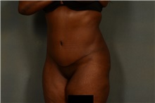 Tummy Tuck After Photo by Ellen Janetzke, MD; Bloomfield Hills, MI - Case 45633