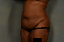 Tummy Tuck Before Photo by Ellen Janetzke, MD; Bloomfield Hills, MI - Case 45633