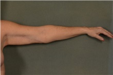 Arm Lift After Photo by Ellen Janetzke, MD; Bloomfield Hills, MI - Case 45918