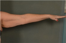Arm Lift Before Photo by Ellen Janetzke, MD; Bloomfield Hills, MI - Case 45918