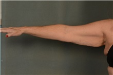 Arm Lift Before Photo by Ellen Janetzke, MD; Bloomfield Hills, MI - Case 45918