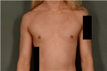 Male Breast Reduction After Photo by Ellen Janetzke, MD; Bloomfield Hills, MI - Case 45920