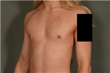 Male Breast Reduction After Photo by Ellen Janetzke, MD; Bloomfield Hills, MI - Case 45920