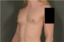 Male Breast Reduction Before Photo by Ellen Janetzke, MD; Bloomfield Hills, MI - Case 45920