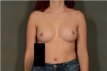 Breast Augmentation After Photo by Ellen Janetzke, MD; Bloomfield Hills, MI - Case 45921