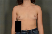 Breast Augmentation Before Photo by Ellen Janetzke, MD; Bloomfield Hills, MI - Case 45921