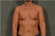 Breast Augmentation Before Photo by Ellen Janetzke, MD; Bloomfield Hills, MI - Case 45922
