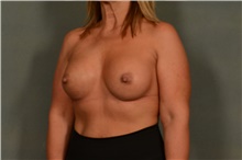 Breast Augmentation After Photo by Ellen Janetzke, MD; Bloomfield Hills, MI - Case 45922