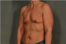 Breast Augmentation Before Photo by Ellen Janetzke, MD; Bloomfield Hills, MI - Case 45922