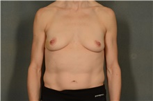 Breast Augmentation Before Photo by Ellen Janetzke, MD; Bloomfield Hills, MI - Case 45923