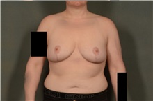 Breast Reduction After Photo by Ellen Janetzke, MD; Bloomfield Hills, MI - Case 45944