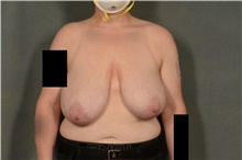 Breast Reduction Before Photo by Ellen Janetzke, MD; Bloomfield Hills, MI - Case 45944