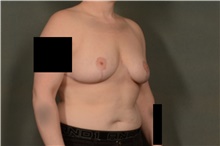 Breast Reduction After Photo by Ellen Janetzke, MD; Bloomfield Hills, MI - Case 45944