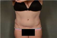 Tummy Tuck After Photo by Ellen Janetzke, MD; Bloomfield Hills, MI - Case 46269