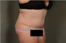 Tummy Tuck After Photo by Ellen Janetzke, MD; Bloomfield Hills, MI - Case 46269