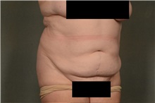 Tummy Tuck Before Photo by Ellen Janetzke, MD; Bloomfield Hills, MI - Case 46269