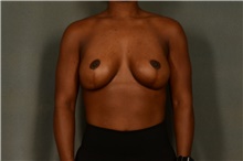 Breast Augmentation After Photo by Ellen Janetzke, MD; Bloomfield Hills, MI - Case 46272