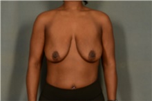 Breast Augmentation Before Photo by Ellen Janetzke, MD; Bloomfield Hills, MI - Case 46272