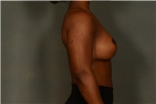 Breast Augmentation After Photo by Ellen Janetzke, MD; Bloomfield Hills, MI - Case 46272