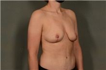 Breast Lift After Photo by Ellen Janetzke, MD; Bloomfield Hills, MI - Case 46273