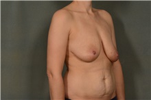 Breast Lift Before Photo by Ellen Janetzke, MD; Bloomfield Hills, MI - Case 46273