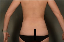 Liposuction After Photo by Ellen Janetzke, MD; Bloomfield Hills, MI - Case 46274