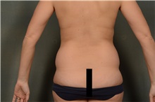 Liposuction Before Photo by Ellen Janetzke, MD; Bloomfield Hills, MI - Case 46274