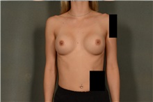 Breast Augmentation After Photo by Ellen Janetzke, MD; Bloomfield Hills, MI - Case 46277