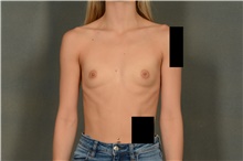 Breast Augmentation Before Photo by Ellen Janetzke, MD; Bloomfield Hills, MI - Case 46277