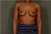 Breast Lift After Photo by Ellen Janetzke, MD; Bloomfield Hills, MI - Case 46278