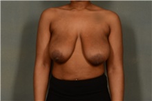 Breast Lift Before Photo by Ellen Janetzke, MD; Bloomfield Hills, MI - Case 46278