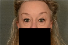 Eyelid Surgery Before Photo by Ellen Janetzke, MD; Bloomfield Hills, MI - Case 46279