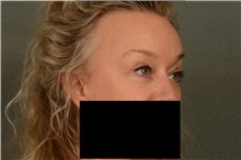 Eyelid Surgery After Photo by Ellen Janetzke, MD; Bloomfield Hills, MI - Case 46279