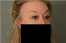 Eyelid Surgery Before Photo by Ellen Janetzke, MD; Bloomfield Hills, MI - Case 46279