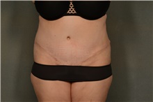 Tummy Tuck After Photo by Ellen Janetzke, MD; Bloomfield Hills, MI - Case 46280