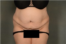 Tummy Tuck Before Photo by Ellen Janetzke, MD; Bloomfield Hills, MI - Case 46280