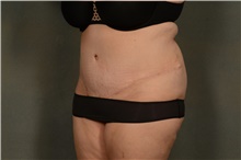 Tummy Tuck After Photo by Ellen Janetzke, MD; Bloomfield Hills, MI - Case 46280