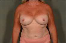 Breast Implant Revision After Photo by Ellen Janetzke, MD; Bloomfield Hills, MI - Case 46514