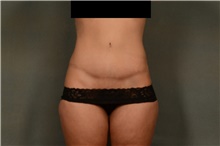 Tummy Tuck After Photo by Ellen Janetzke, MD; Bloomfield Hills, MI - Case 46515