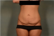 Tummy Tuck Before Photo by Ellen Janetzke, MD; Bloomfield Hills, MI - Case 46515