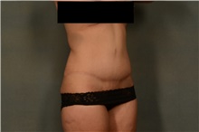 Tummy Tuck After Photo by Ellen Janetzke, MD; Bloomfield Hills, MI - Case 46515